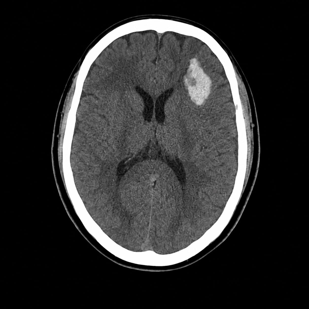 Non-contrast head CT before AI analysis